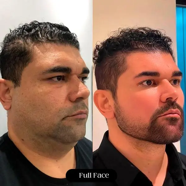 Antes e depois de harmonização orofacial full face