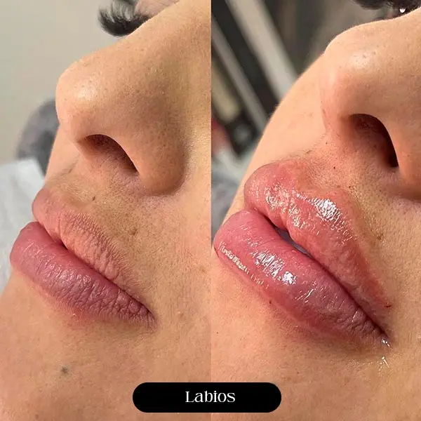Antes e depois de preenchimento labial
