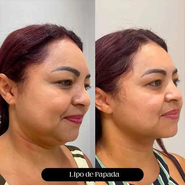 Antes e depois de lipo de papada