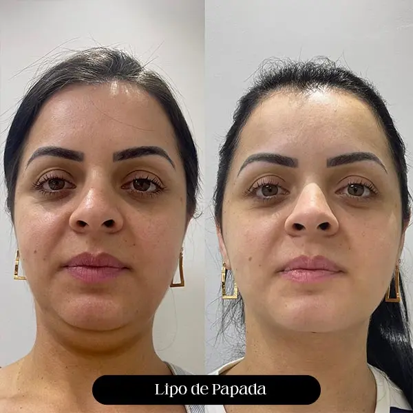 Antes e depois de lipo de papada, vista frontal