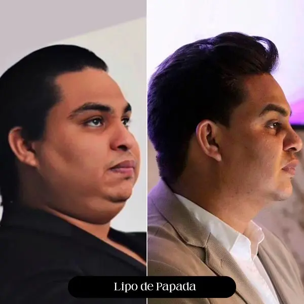 Antes e depois de lipo de papada, vista de perfil