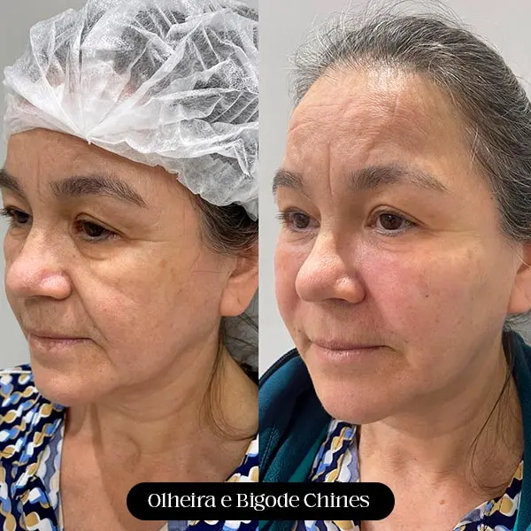 Antes e depois de preenchimento de olheira e bigode chinês