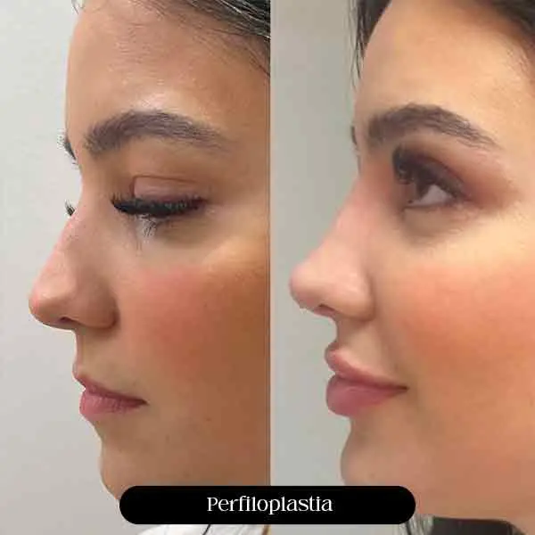 Antes e depois de perfiloplastia