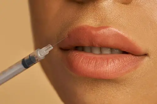 Preenchimento labial com ácido hialurônico