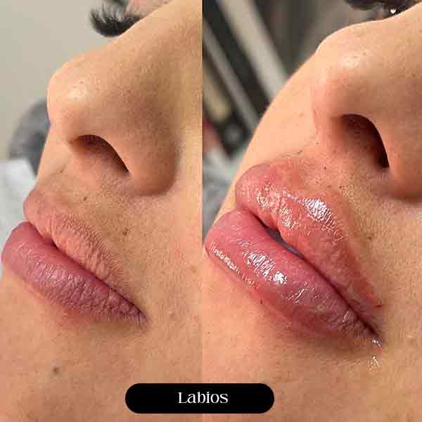 Harmonização Orofacial Preenchimento Labial