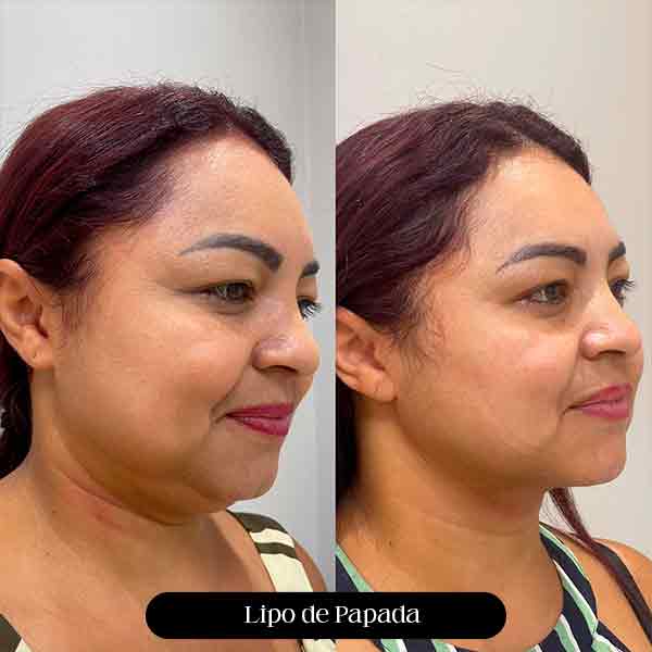 Harmonização Orofacial Lipo de Papa em São Paulo