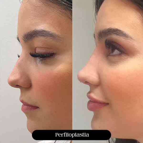 Harmonização Orofacial Perlifoplastia em São Paulo