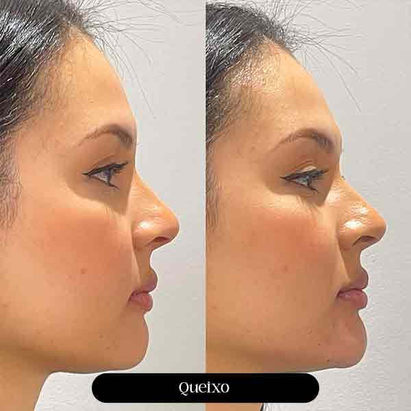 Harmonização Orofacial Queixo